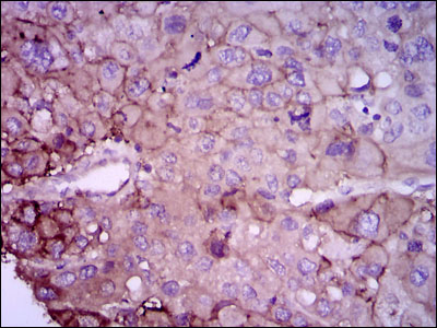 Immunohistochemical analysis of paraffin-embedded liver cancer tissues using RAB4A mouse mAb with DAB staining.