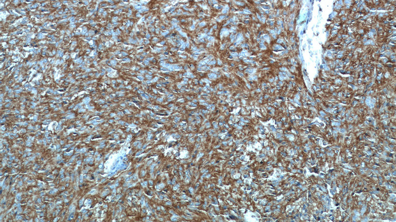 Immunohistochemistry of paraffin-embedded stromal tumor tissue slide using Catalog No:116104(ANO1,DOG1 Antibody) at dilution of 1:50 (under 10x lens)