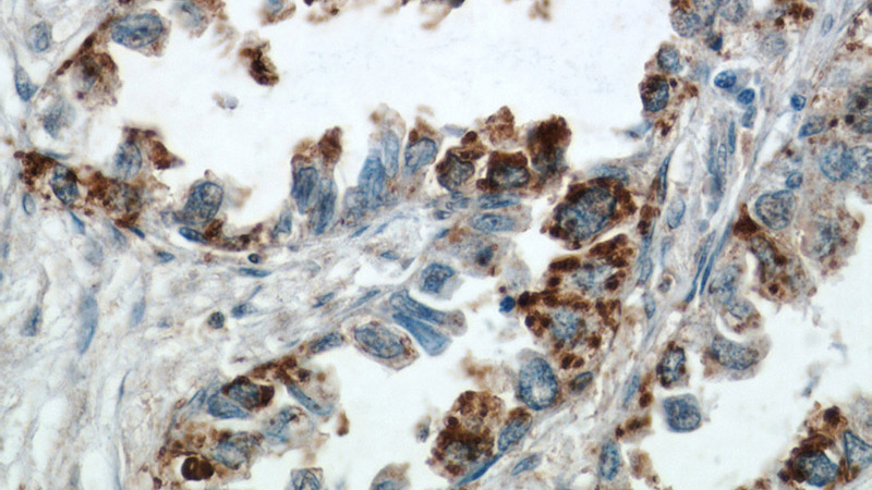 Immunohistochemical of paraffin-embedded human lung cancer using Catalog No:112071(KISS1 antibody) at dilution of 1:50 (under 40x lens)