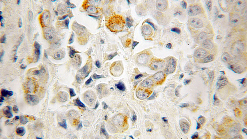 Immunohistochemical of paraffin-embedded human prostate cancer using Catalog No:114859(RTKN antibody) at dilution of 1:100 (under 10x lens)