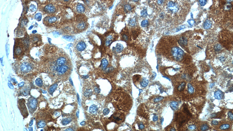 Immunohistochemistry of paraffin-embedded human liver cancer tissue slide using Catalog No:116259(TP53INP1 Antibody) at dilution of 1:50 (under 40x lens)