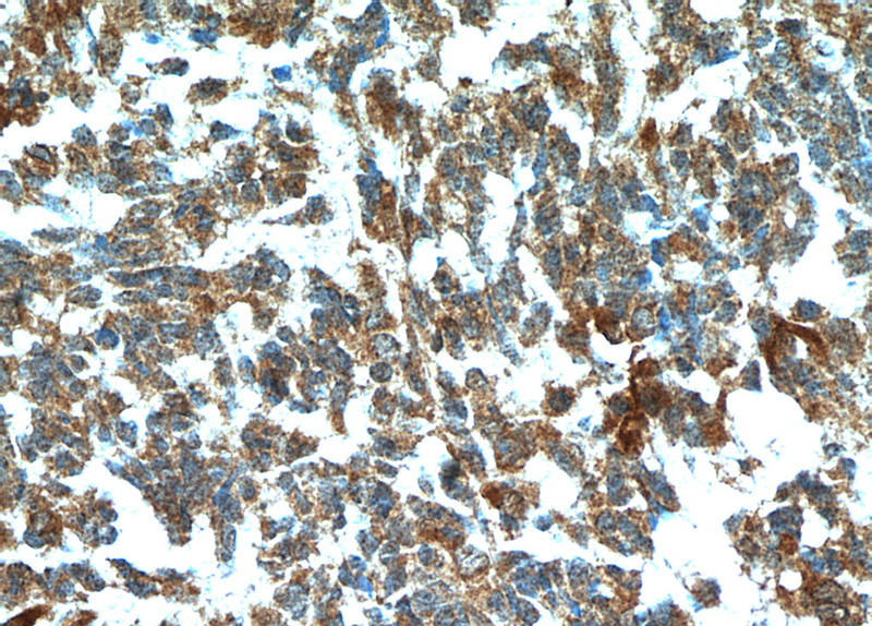Immunohistochemical of paraffin-embedded human gliomas using Catalog No:110443(FABP7 antibody) at dilution of 1:50 (under 40x lens)