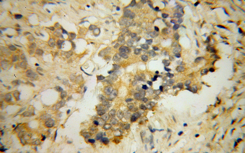Immunohistochemical of paraffin-embedded human gliomas using Catalog No:112001(KIF17 antibody) at dilution of 1:100 (under 40x lens)