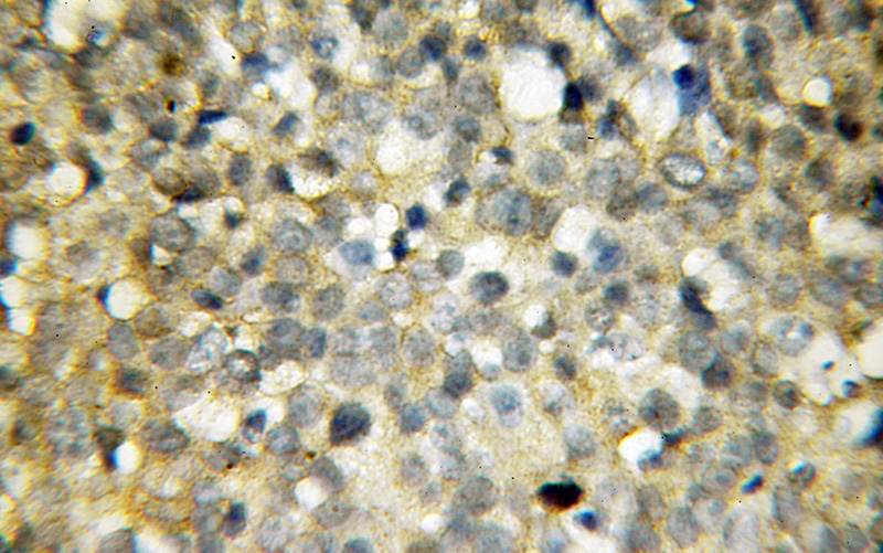 Immunohistochemical of paraffin-embedded human ovary tumor using Catalog No:113721(PRDX2 antibody) at dilution of 1:50 (under 10x lens)