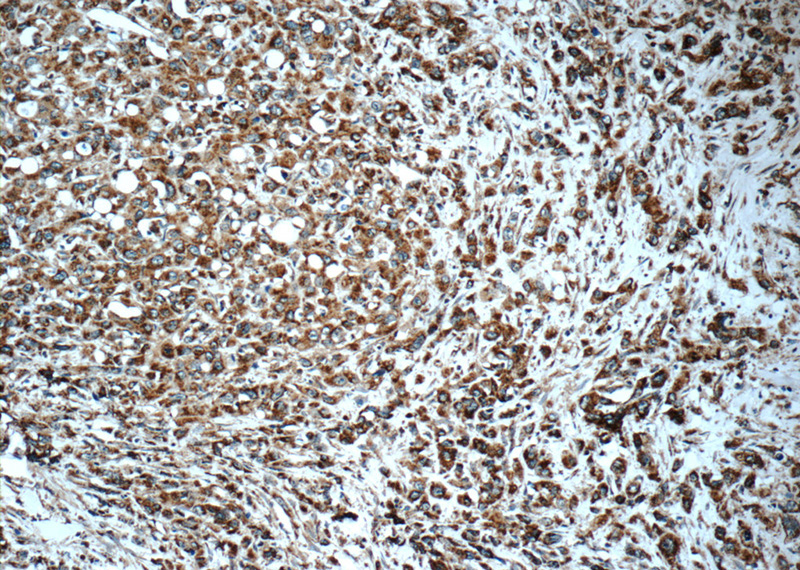 Immunohistochemistry of paraffin-embedded human stomach cancer tissue slide using Catalog No:110121(DUSP6 Antibody) at dilution of 1:100 (under 10x lens)