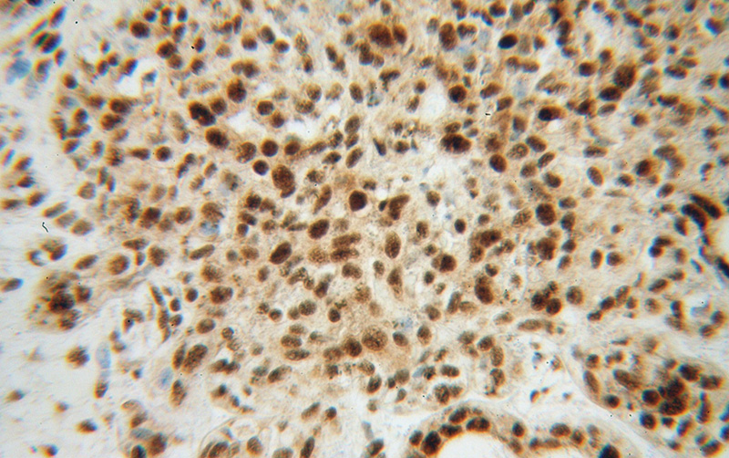 Immunohistochemical of paraffin-embedded human breast cancer using Catalog No:115464(SNRPF antibody) at dilution of 1:100 (under 40x lens)