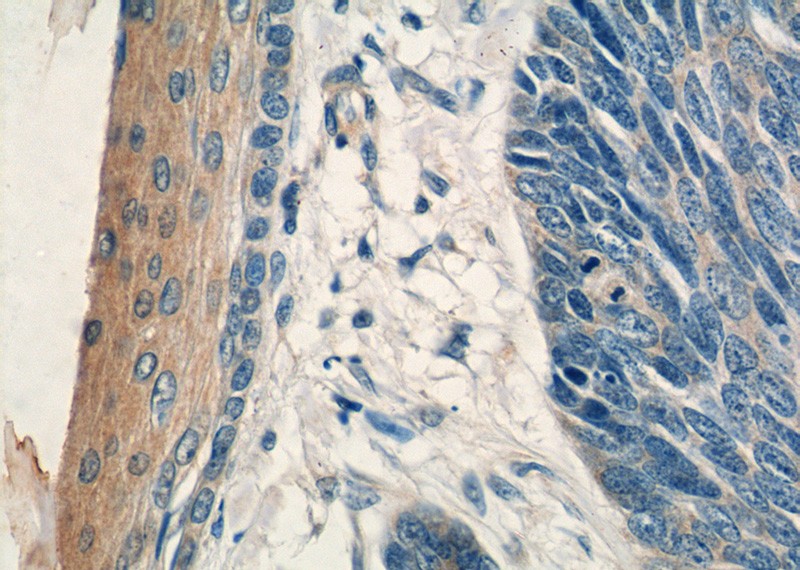 Immunohistochemistry of paraffin-embedded human skin cancer tissue slide using Catalog No:113766(PDCD5 Antibody) at dilution of 1:50 (under 40x lens)
