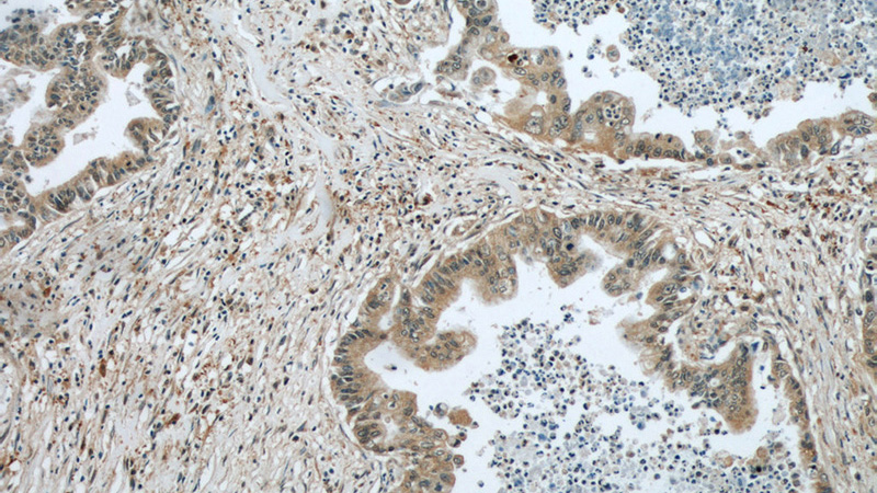 Immunohistochemical of paraffin-embedded human pancreas cancer using Catalog No:114894(RPL38 antibody) at dilution of 1:50 (under 10x lens)