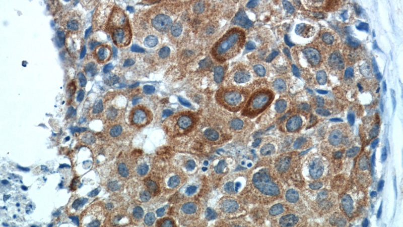 Immunohistochemistry of paraffin-embedded human breast cancer tissue slide using Catalog No:108904(CAST Antibody) at dilution of 1:50 (under 40x lens)