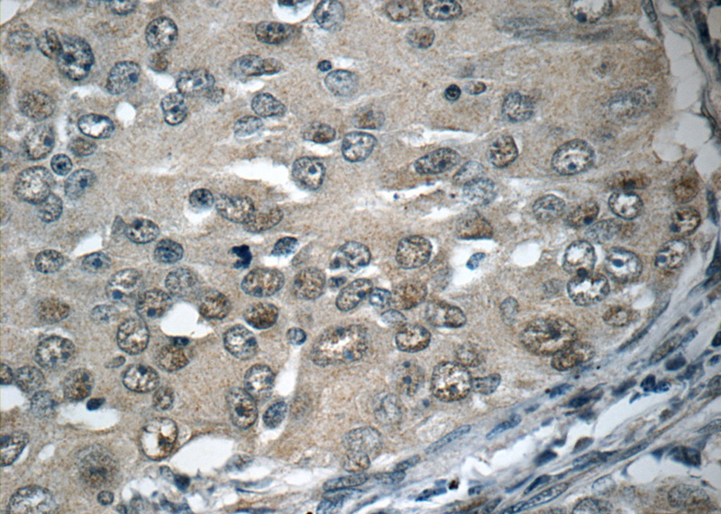 Immunohistochemistry of paraffin-embedded human lung cancer tissue slide using Catalog No:111557(HSF1 Antibody) at dilution of 1:50 (under 40x lens)