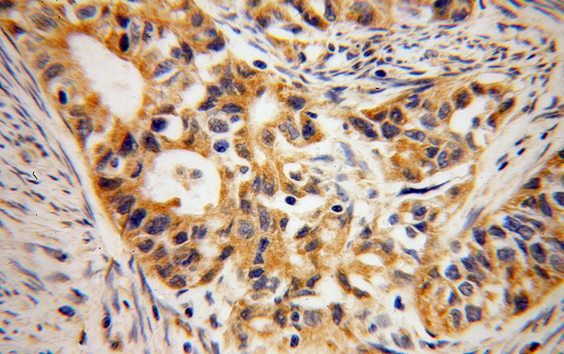Immunohistochemical of paraffin-embedded human endometrial cancer using Catalog No:117090(B3GALTL antibody) at dilution of 1:50 (under 40x lens)