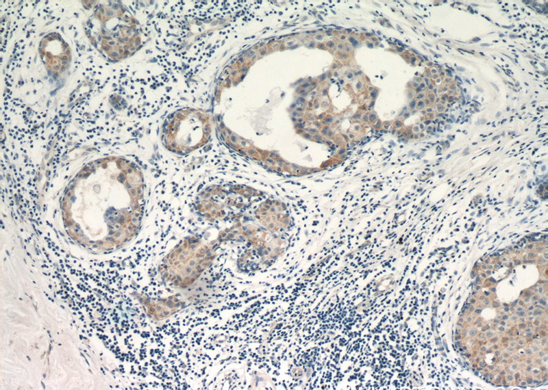 Immunohistochemical of paraffin-embedded human breast cancer using Catalog No:116727(VCPIP1 antibody) at dilution of 1:50 (under 10x lens)