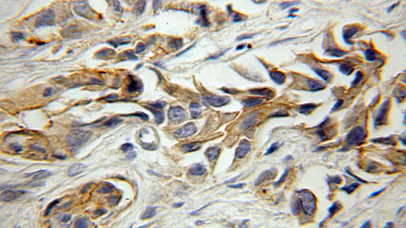 Immunohistochemical of paraffin-embedded human prostate cancer using Catalog No:108346(ATP1B3 antibody) at dilution of 1:50 (under 10x lens)