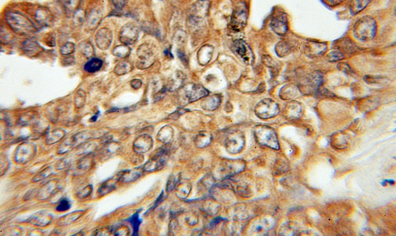Immunohistochemical of paraffin-embedded human ovary tumor using Catalog No:110533(SLC27A4 antibody) at dilution of 1:50 (under 10x lens)
