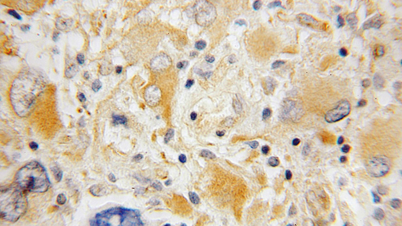 Immunohistochemical of paraffin-embedded human gliomas using Catalog No:115776(SYT4 antibody) at dilution of 1:100 (under 10x lens)