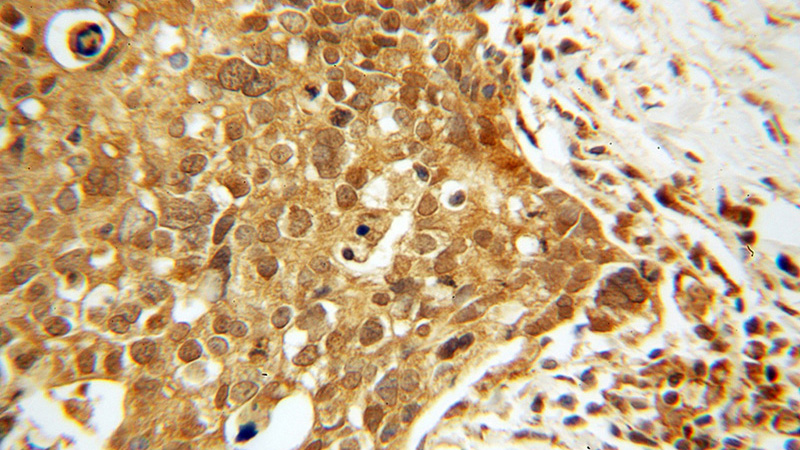 Immunohistochemical of paraffin-embedded human ovary tumor using Catalog No:116477(TTF2 antibody) at dilution of 1:100 (under 40x lens)