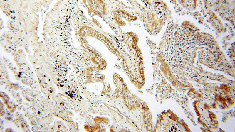 Immunohistochemical of paraffin-embedded human lung cancer using Catalog No:109069(CCNI2 antibody) at dilution of 1:100 (under 10x lens)