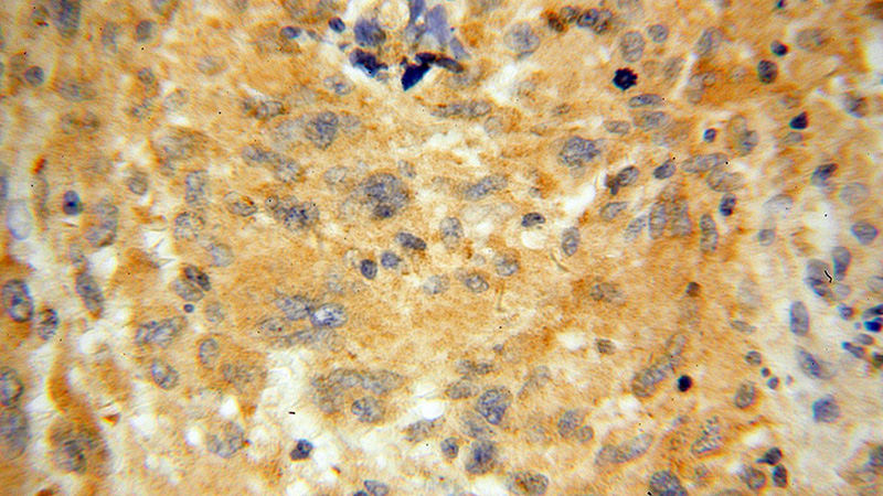 Immunohistochemical of paraffin-embedded human gliomas using Catalog No:112947(NAPB antibody) at dilution of 1:100 (under 40x lens)