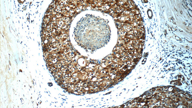 Immunohistochemistry of paraffin-embedded human breast cancer slide using Catalog No:109147(CD9 Antibody) at dilution of 1:50