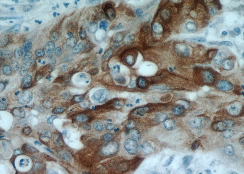 Immunohistochemical of paraffin-embedded human cervical cancer using Catalog No:109798(KRT17-Specific antibody) at dilution of 1:50 (under 40x lens)