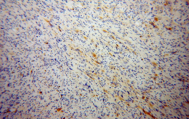 Immunohistochemical of paraffin-embedded human gliomas using Catalog No:114649(RGS7 antibody) at dilution of 1:50 (under 10x lens)