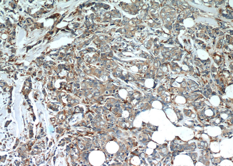 Immunohistochemistry of paraffin-embedded human breast cancer slide using Catalog No:112463(SCGB2A2 Antibody) at dilution of 1:50