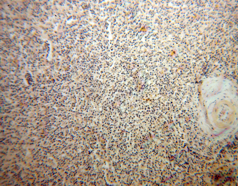 Immunohistochemical of paraffin-embedded human lymphoma using Catalog No:107755(ACVRL1 antibody) at dilution of 1:50 (under 10x lens)