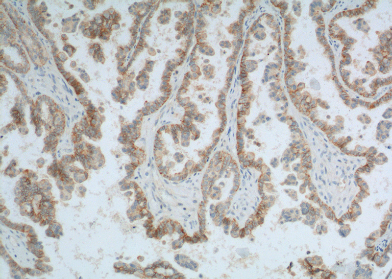 Immunohistochemistry of paraffin-embedded human ovary tumor tissue slide using Catalog No:109127(CD47 Antibody) at dilution of 1:200 (under 10x lens). heat mediated antigen retrieved with Tris-EDTA buffer(pH9).
