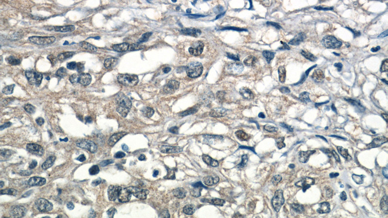 Immunohistochemistry of paraffin-embedded human cervical cancer tissue slide using Catalog No:111557(HSF1 Antibody) at dilution of 1:50 (under 40x lens)