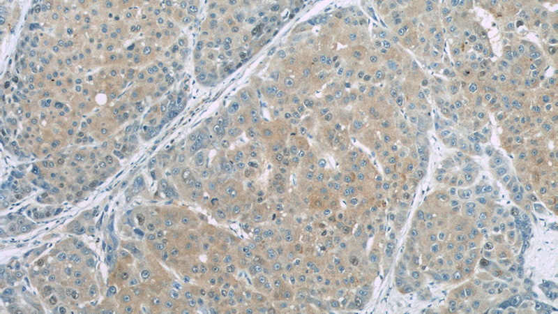 Immunohistochemistry of paraffin-embedded human liver cancer slide using Catalog No:107287(CSE Antibody) at dilution of 1:50