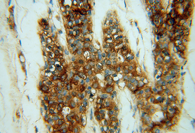 Immunohistochemical of paraffin-embedded human colon cancer using Catalog No:109293(CHST12 antibody) at dilution of 1:50 (under 40x lens)