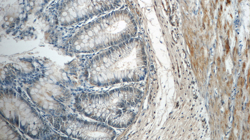 Immunohistochemistry of paraffin-embedded human colon tissue slide using Catalog No:107719(ACADL-Specific Antibody) at dilution of 1:50 (under 10x lens)