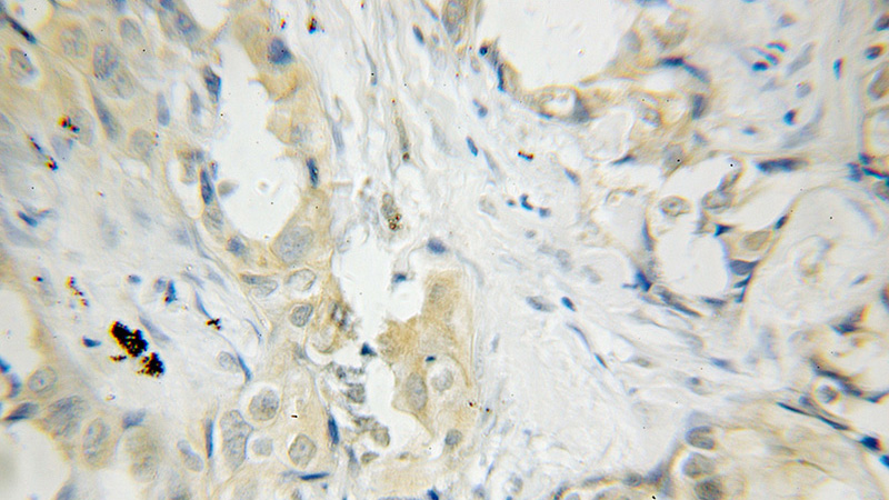 Immunohistochemical of paraffin-embedded human lung cancer using Catalog No:113953(PLEK antibody) at dilution of 1:50 (under 40x lens)