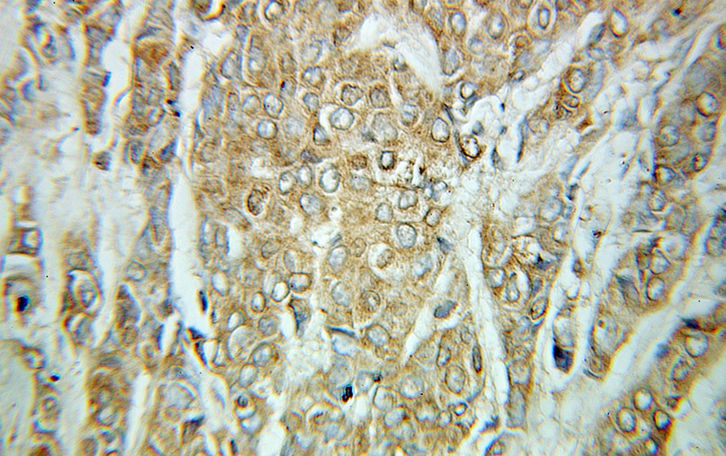 Immunohistochemical of paraffin-embedded human breast cancer using Catalog No:114187(PRG2 antibody) at dilution of 1:100 (under 10x lens)