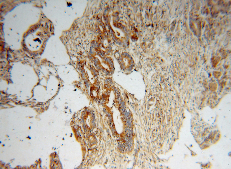 Immunohistochemical of paraffin-embedded human colon cancer using Catalog No:112970(MYL9 antibody) at dilution of 1:50 (under 10x lens)