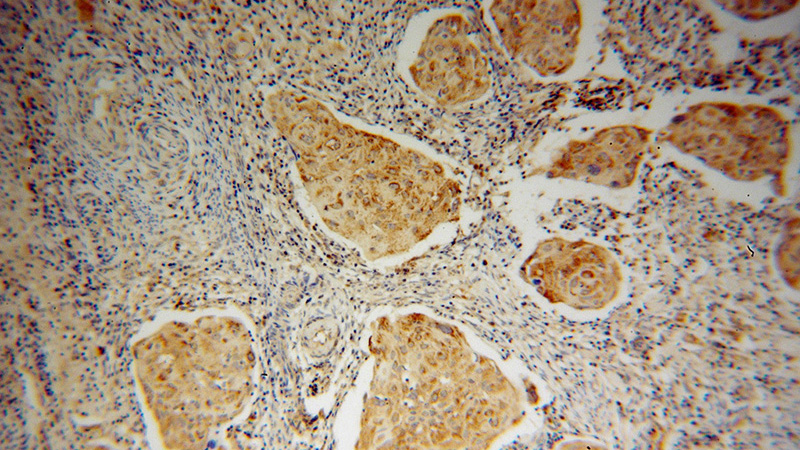 Immunohistochemical of paraffin-embedded human cervical cancer using Catalog No:107807(ABCG1 antibody) at dilution of 1:100 (under 10x lens)