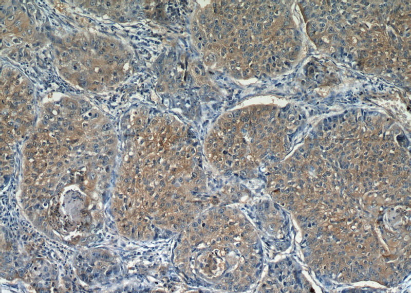 Immunohistochemical of paraffin-embedded human lung cancer using Catalog No:108719(C3orf10 antibody) at dilution of 1:50 (under 10x lens)