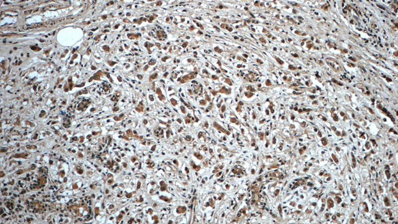 Immunohistochemistry of paraffin-embedded human breast cancer tissue slide using Catalog No:115802(SDCBP2 Antibody) at dilution of 1:50 (under 10x lens)