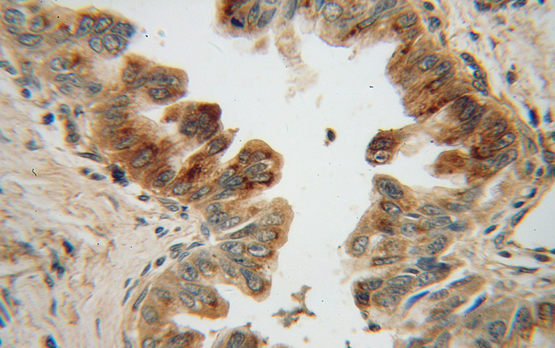 Immunohistochemical of paraffin-embedded human pancreas cancer using Catalog No:112832(MRPL48 antibody) at dilution of 1:50 (under 40x lens)