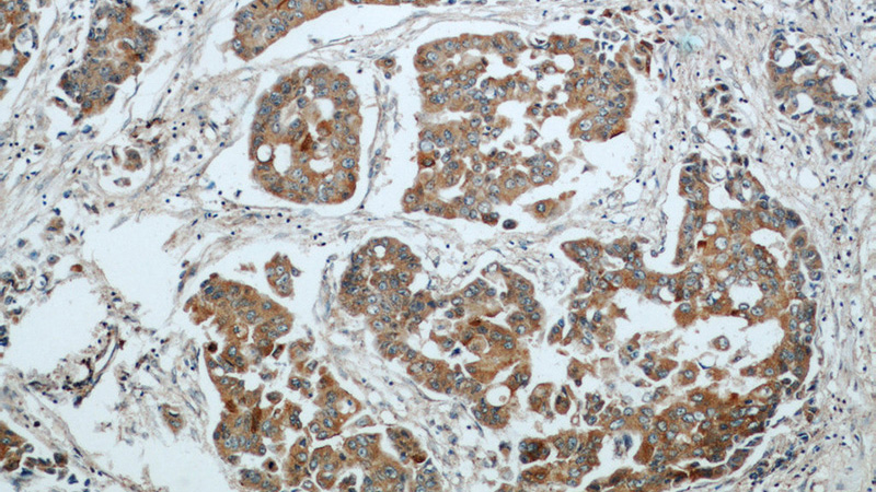 Immunohistochemical of paraffin-embedded human breast cancer using Catalog No:116267(TPM2 antibody) at dilution of 1:50 (under 10x lens)