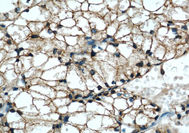 Immunohistochemical of paraffin-embedded human nephroblastoma using Catalog No:113310(NOV antibody) at dilution of 1:50 (under 40x lens)