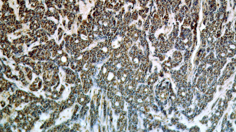 Immunohistochemical of paraffin-embedded human cervical cancer using Catalog No:115060(SAP18 antibody) at dilution of 1:50 (under 10x lens)