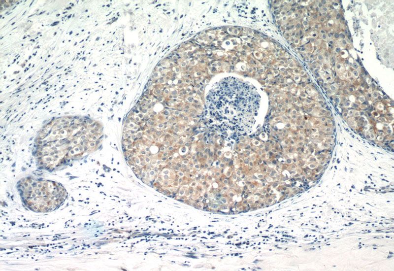 Immunohistochemistry of paraffin-embedded human breast cancer tissue slide using Catalog No:113479(PACSIN2 Antibody) at dilution of 1:400 (under 10x lens)