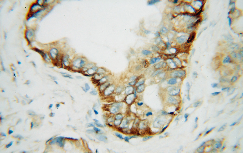 Immunohistochemical of paraffin-embedded human pancreas cancer using Catalog No:114983(SCAMP2 antibody) at dilution of 1:100 (under 40x lens)