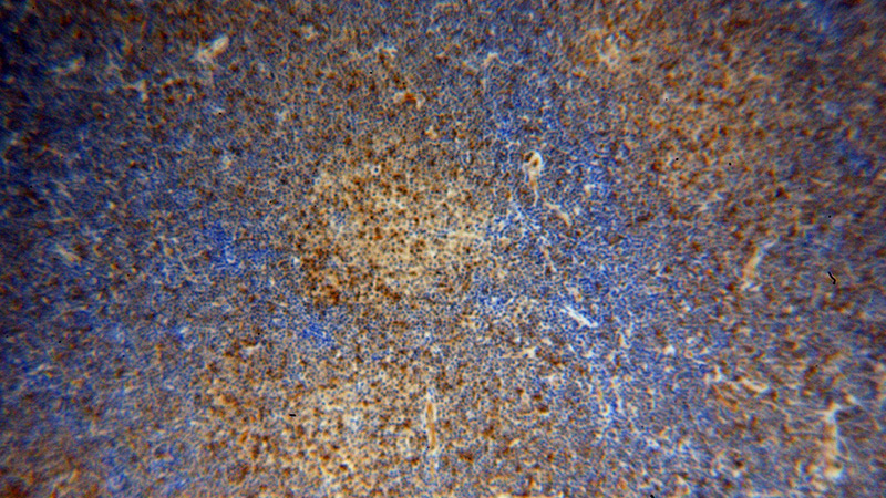 Immunohistochemical of paraffin-embedded human lymphoma using Catalog No:110050(DOK2 antibody) at dilution of 1:100 (under 10x lens)