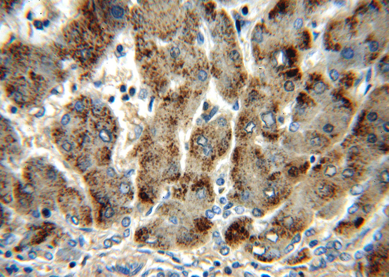 Immunohistochemical of paraffin-embedded human hepatocirrhosis using Catalog No:108884(CAT antibody) at dilution of 1:100 (under 40x lens)