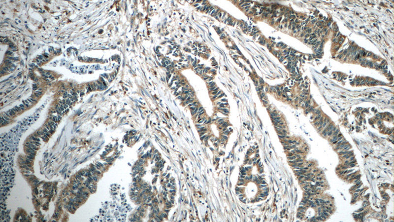 Immunohistochemistry of paraffin-embedded human pancreas cancer tissue slide using Catalog No:112678(MAP3K10 Antibody) at dilution of 1:50 (under 10x lens)