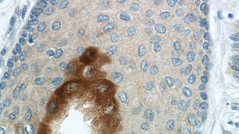 Immunohistochemistry of paraffin-embedded human skin cancer tissue slide using Catalog No:110272(PI3 Antibody) at dilution of 1:50 (under 40x lens)