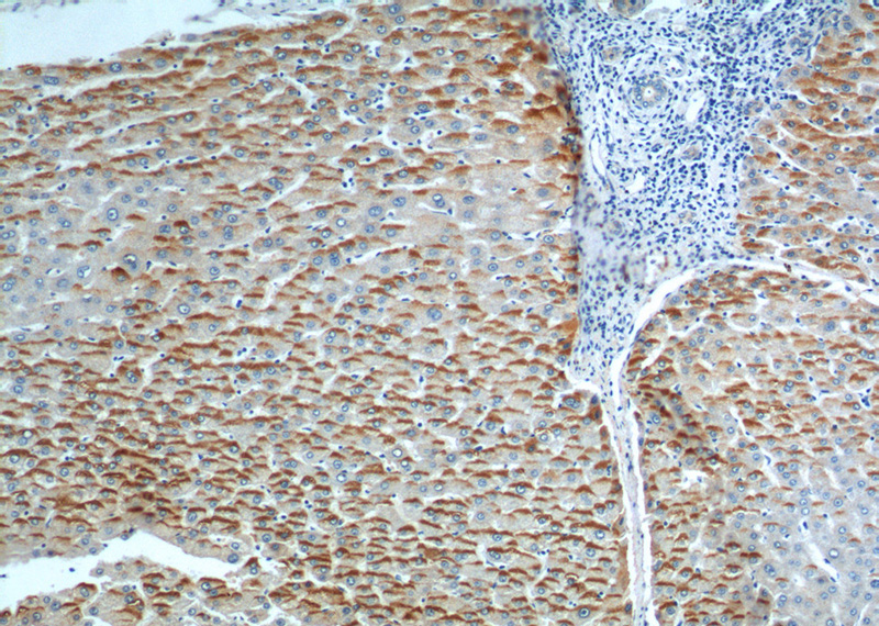 Immunohistochemistry of paraffin-embedded human liver cancer tissue slide using Catalog No:114632(RFTN2 Antibody) at dilution of 1:100 (under 10x lens).
