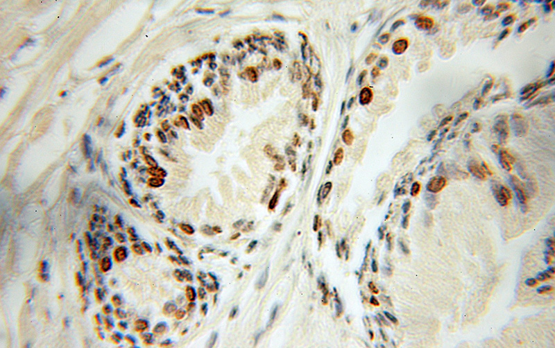 Immunohistochemical of paraffin-embedded human prostate cancer using Catalog No:115152(SFRS7 antibody) at dilution of 1:50 (under 10x lens)